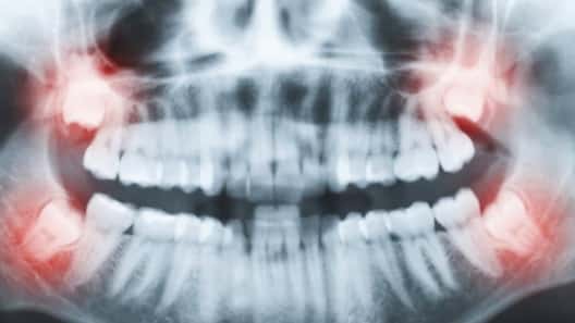 Vừa thoát khỏi ung thư, người phụ nữ lại mất mạng vì nhổ răng khôn