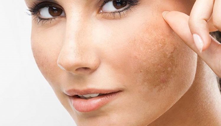 8 cách trị sạm da tại nhà hiệu quả mà không tốn tiền