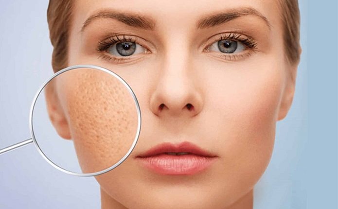 7 nguyên liệu trị lỗ chân lông to hiệu quả ngay tức thì