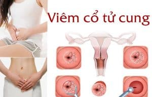 5 triệu chứng viêm cổ tử cung dễ nhận biết nhất