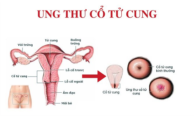 Cần biết: Ai dễ mắc ung thư cổ tử cung? Cần biết: Ai dễ mắc ung thư cổ tử cung?