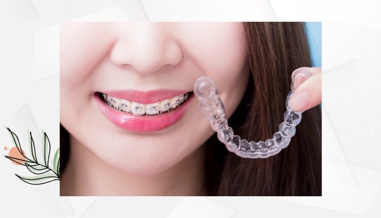 7 Kinh nghiệm niềng răng bạn cần lưu ý